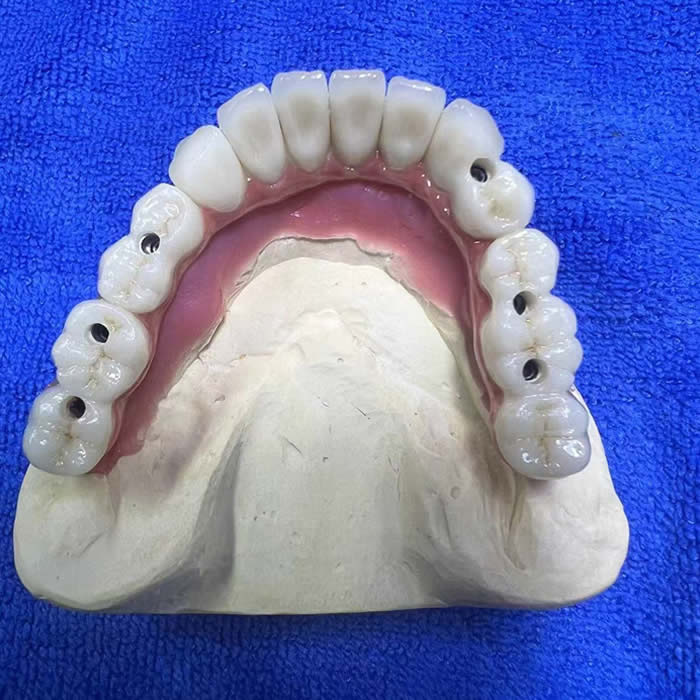 Zirconia Implant 06