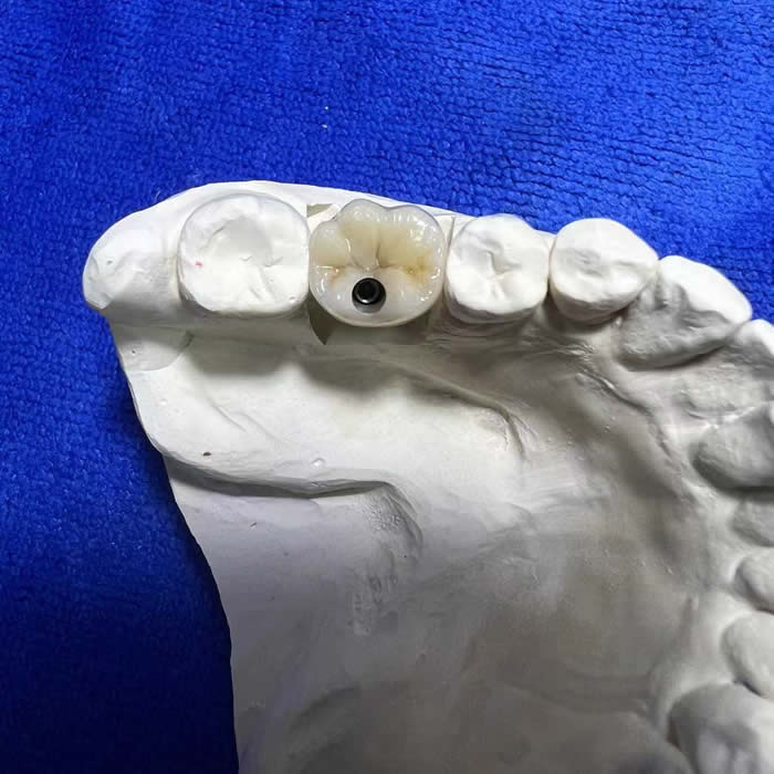 Zirconia Implant 08