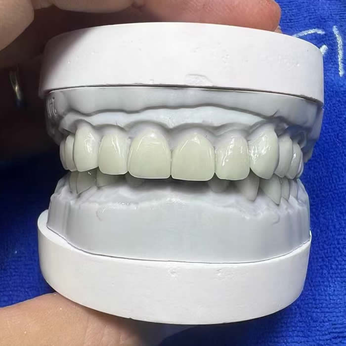 E.max Tooth Crowns 04